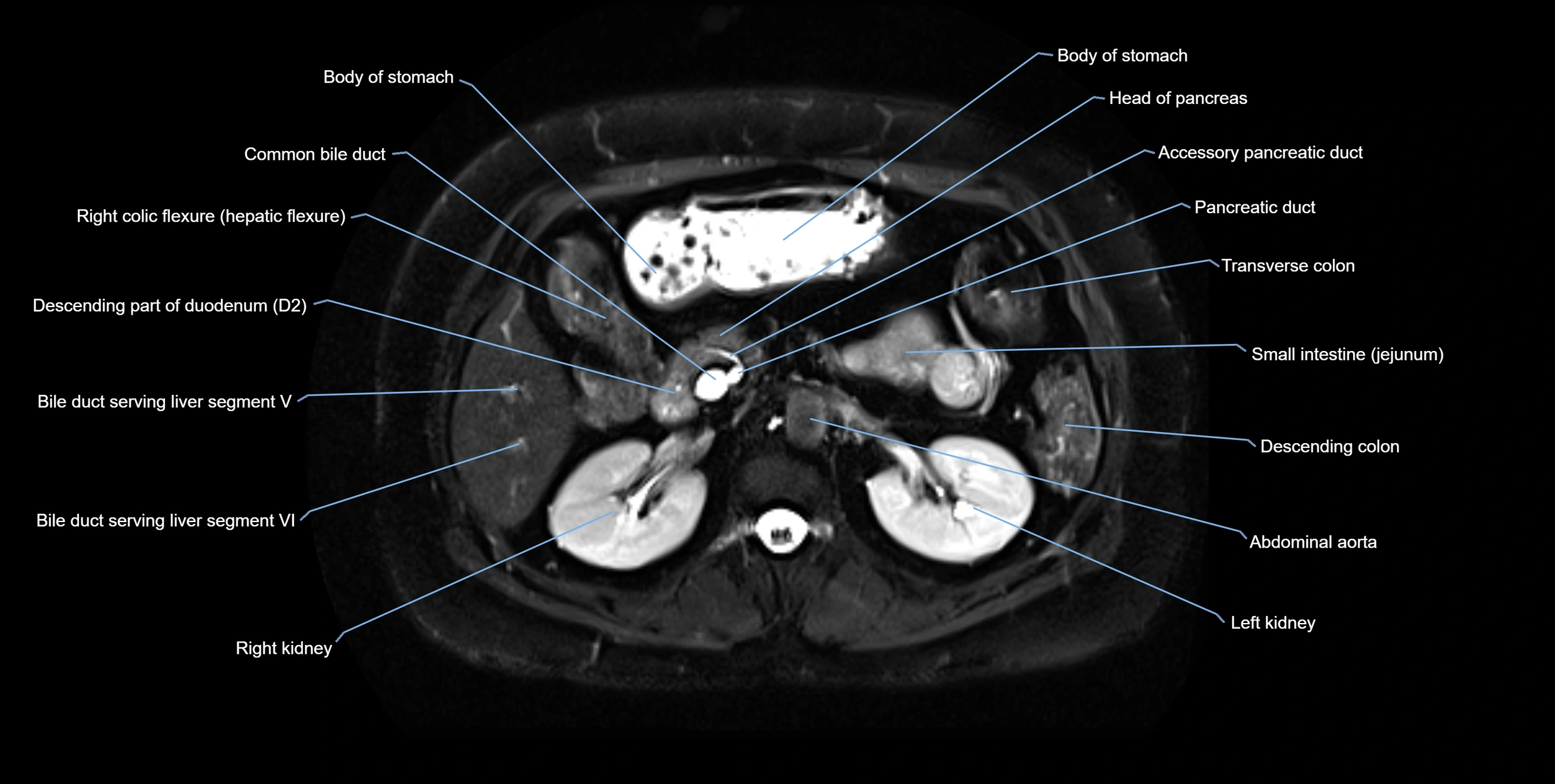 MRI MRCP axial cross sectional anatomy 3T radiology  image-img-10001-00025.webp